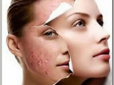 Tratamento Anti Acne com Laser e Peeling