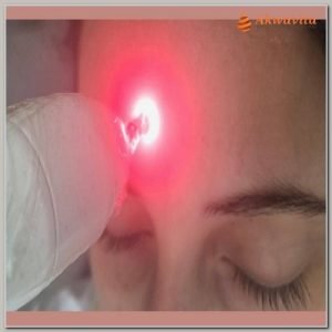 Laser em Manchas Olheiras Acnes e Rejuvenescimento