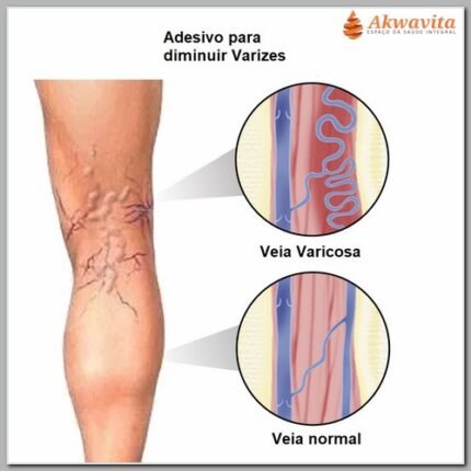 Adesivo de Ervas Para Varizes Vasinhos melhora a Circulação